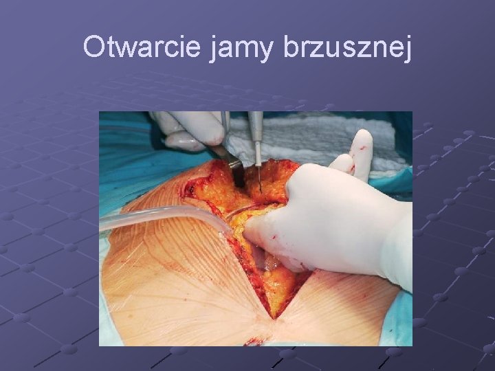 Otwarcie jamy brzusznej 