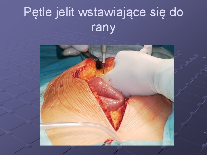 Pętle jelit wstawiające się do rany 