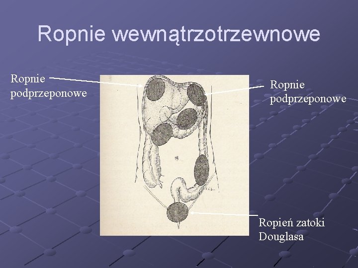 Ropnie wewnątrzotrzewnowe Ropnie podprzeponowe Ropień zatoki Douglasa 