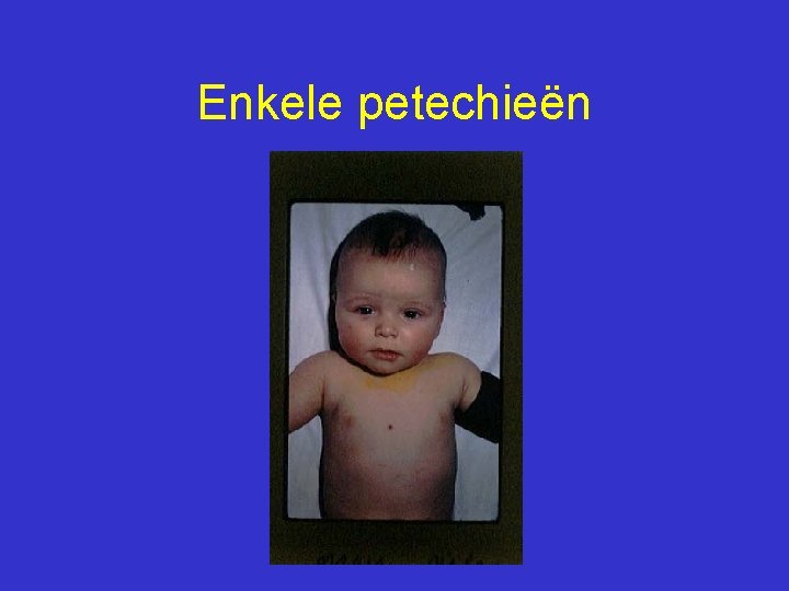 Enkele petechieën 