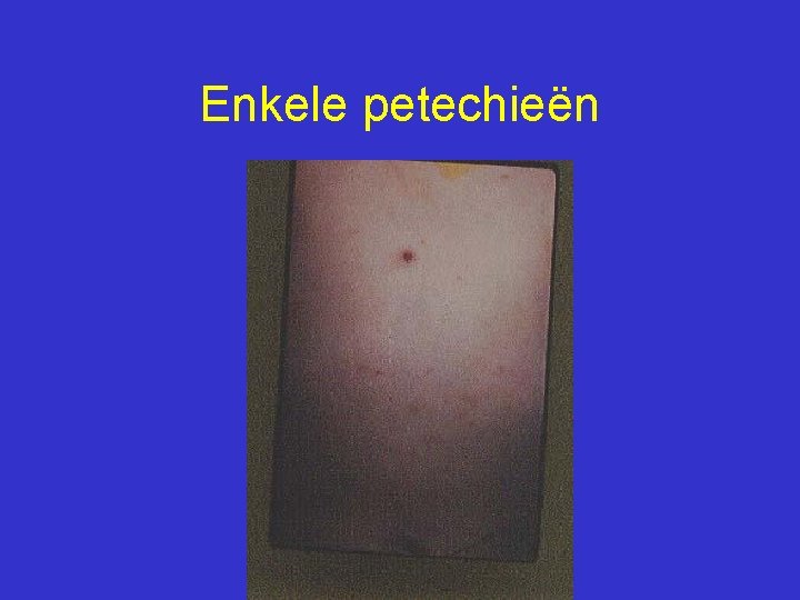 Enkele petechieën 