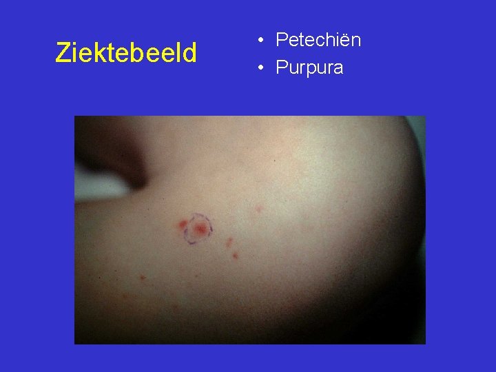 Ziektebeeld • Petechiën • Purpura 