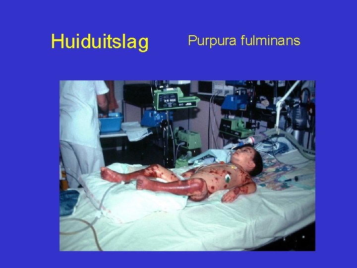 Huiduitslag Purpura fulminans 