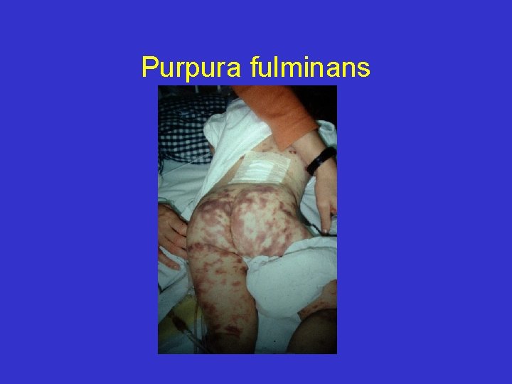 Purpura fulminans 