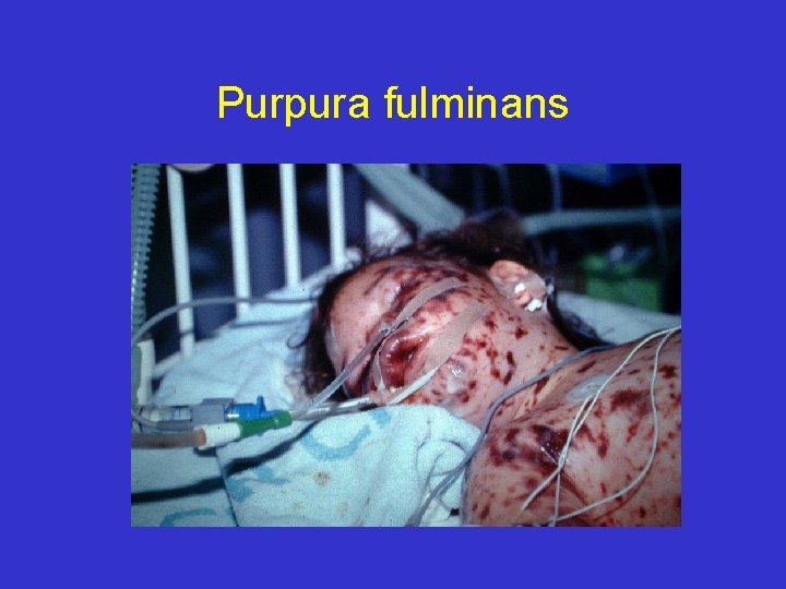 Purpura fulminans 