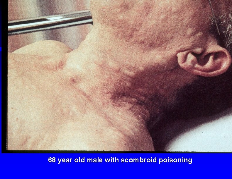 68 year old male with scombroid poisoning 