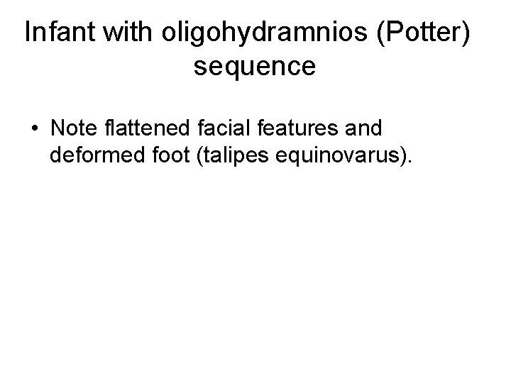 Infant with oligohydramnios (Potter) sequence • Note flattened facial features and deformed foot (talipes