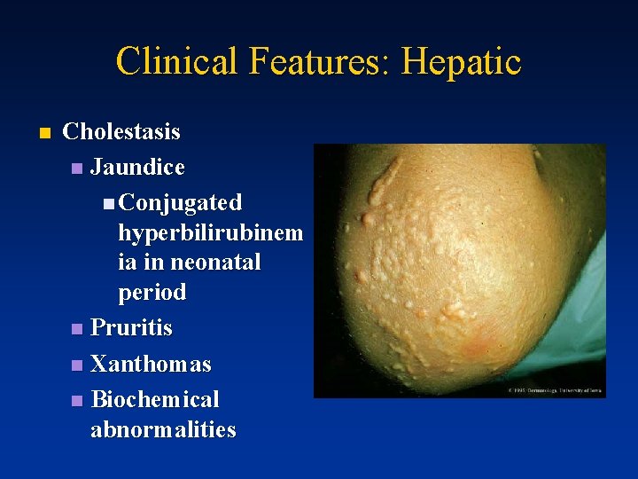 Clinical Features: Hepatic n Cholestasis n Jaundice n Conjugated hyperbilirubinem ia in neonatal period