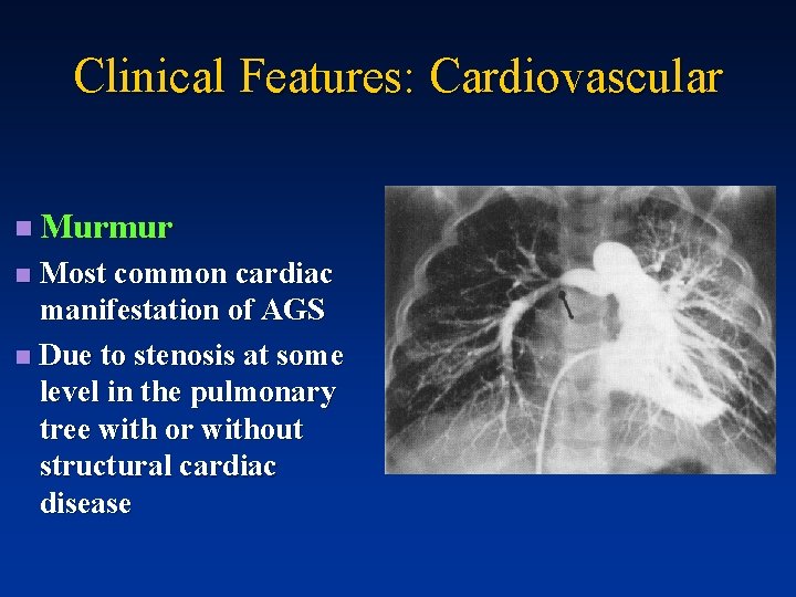 Clinical Features: Cardiovascular n Murmur Most common cardiac manifestation of AGS n Due to