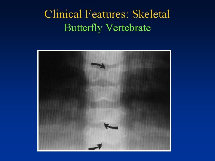 Clinical Features: Skeletal Butterfly Vertebrate 