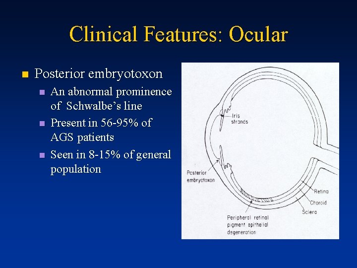 Clinical Features: Ocular n Posterior embryotoxon n An abnormal prominence of Schwalbe’s line Present