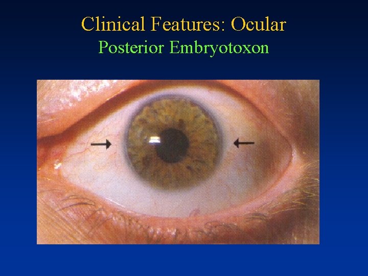 Clinical Features: Ocular Posterior Embryotoxon 
