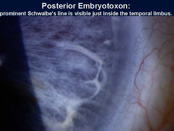 Posterior Embryotoxon: prominent Schwalbe's line is visible just inside the temporal limbus. 