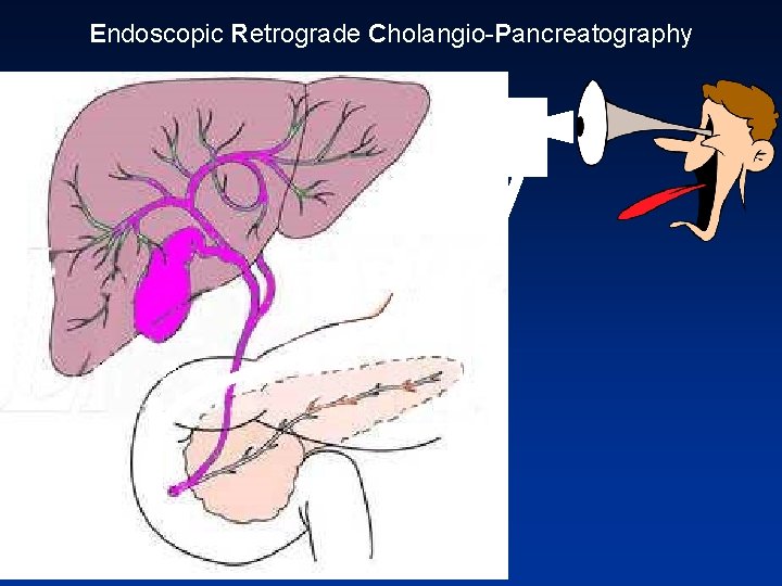 Endoscopic Retrograde Cholangio Pancreatography 