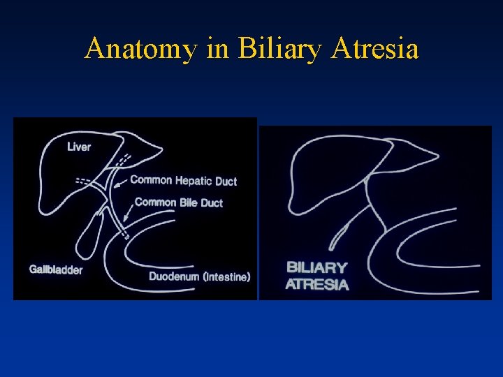 Anatomy in Biliary Atresia 
