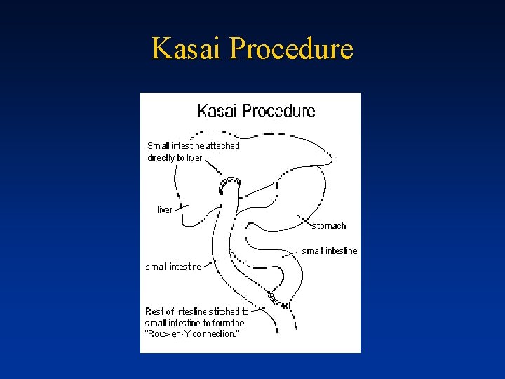 Kasai Procedure 