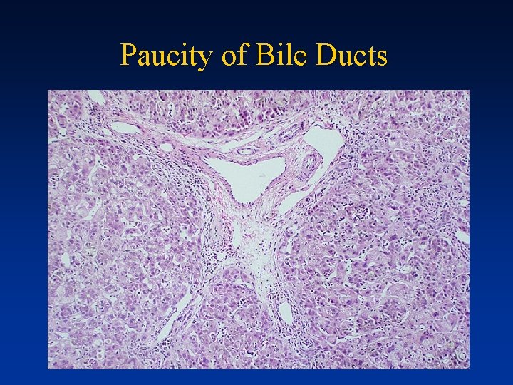 Paucity of Bile Ducts 