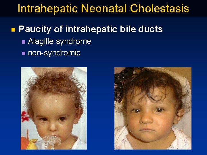 Intrahepatic Neonatal Cholestasis n Paucity of intrahepatic bile ducts Alagille syndrome n non syndromic