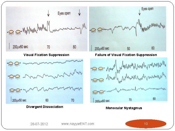 Visual Fixation Suppression Divergent Dissociation 28 -07 -2012 www. nayyar. ENT. com Failure of