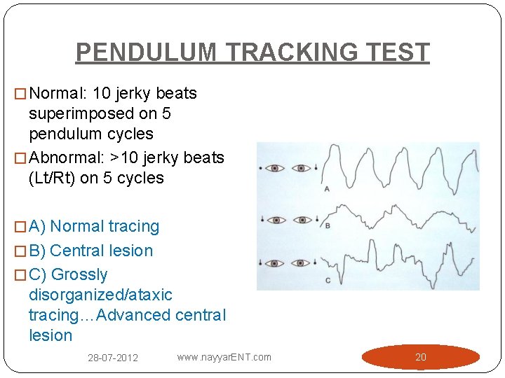 PENDULUM TRACKING TEST � Normal: 10 jerky beats superimposed on 5 pendulum cycles �