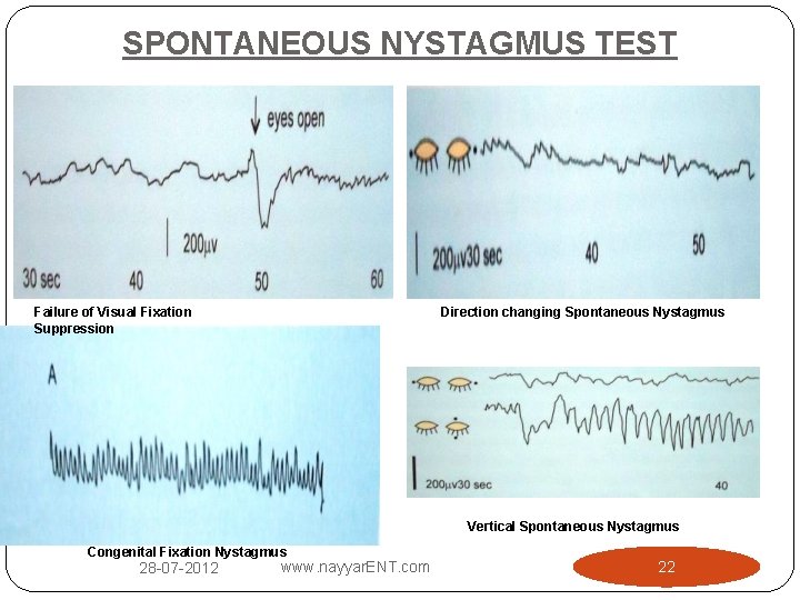 SPONTANEOUS NYSTAGMUS TEST Failure of Visual Fixation Suppression Direction changing Spontaneous Nystagmus Vertical Spontaneous