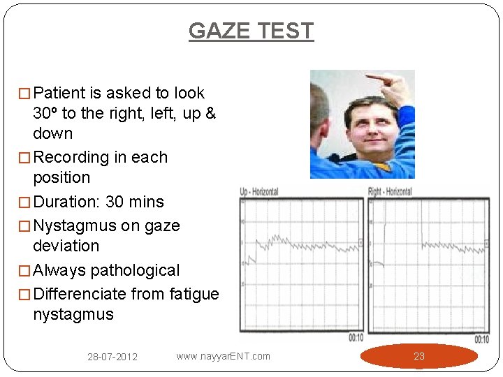 GAZE TEST � Patient is asked to look 30º to the right, left, up