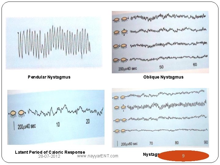 Pendular Nystagmus Latent Period of Caloric Response www. nayyar. ENT. com 28 -07 -2012