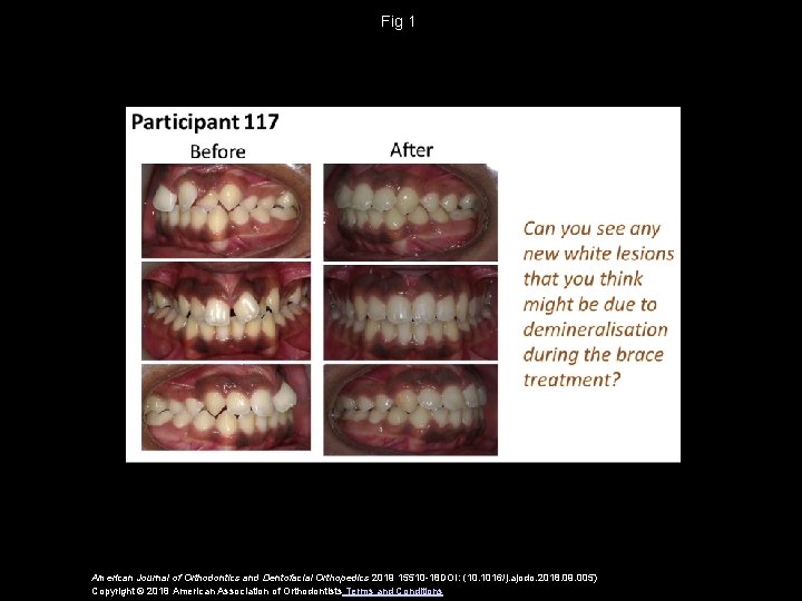 Fig 1 American Journal of Orthodontics and Dentofacial Orthopedics 2019 15510 -18 DOI: (10.