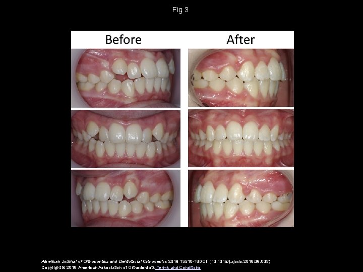 Fig 3 American Journal of Orthodontics and Dentofacial Orthopedics 2019 15510 -18 DOI: (10.