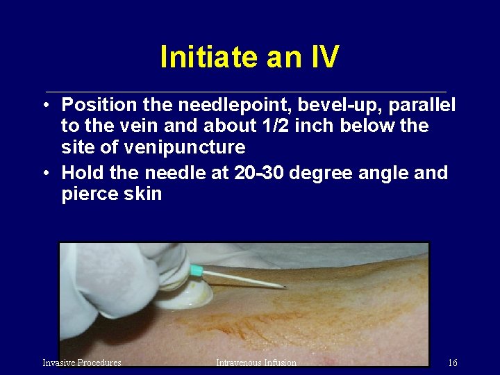 Initiate an IV • Position the needlepoint, bevel-up, parallel to the vein and about