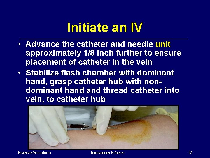 Initiate an IV • Advance the catheter and needle unit approximately 1/8 inch further