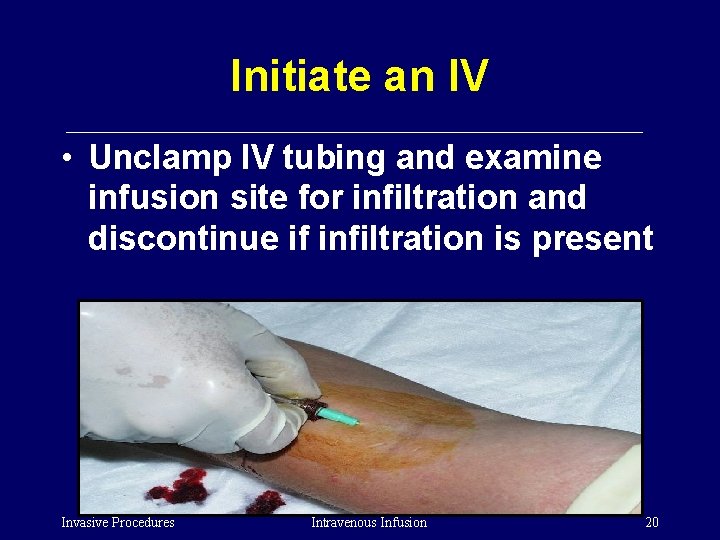 Initiate an IV • Unclamp IV tubing and examine infusion site for infiltration and