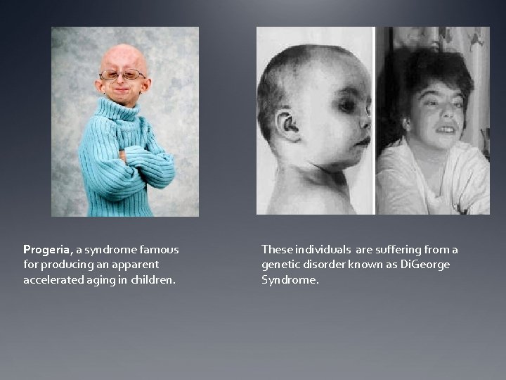 Progeria, a syndrome famous for producing an apparent accelerated aging in children. These individuals Progeria, a syndrome famous for producing an apparent accelerated aging in children. These individuals