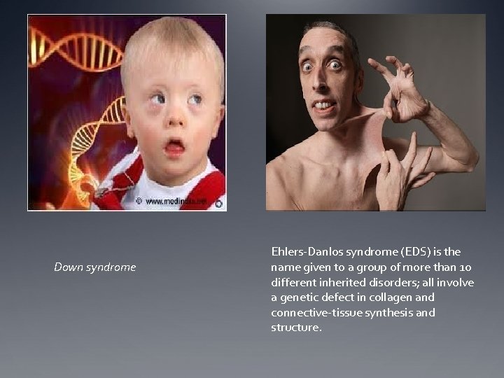 Down syndrome Ehlers-Danlos syndrome (EDS) is the name given to a group of more Down syndrome Ehlers-Danlos syndrome (EDS) is the name given to a group of more