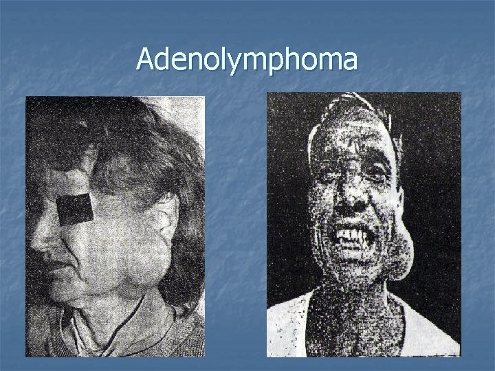 Adenolymphoma 