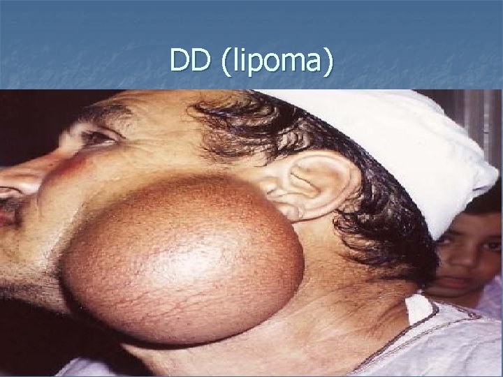 DD (lipoma) 