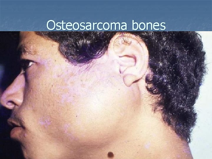 Osteosarcoma bones 
