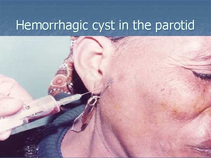 Hemorrhagic cyst in the parotid 