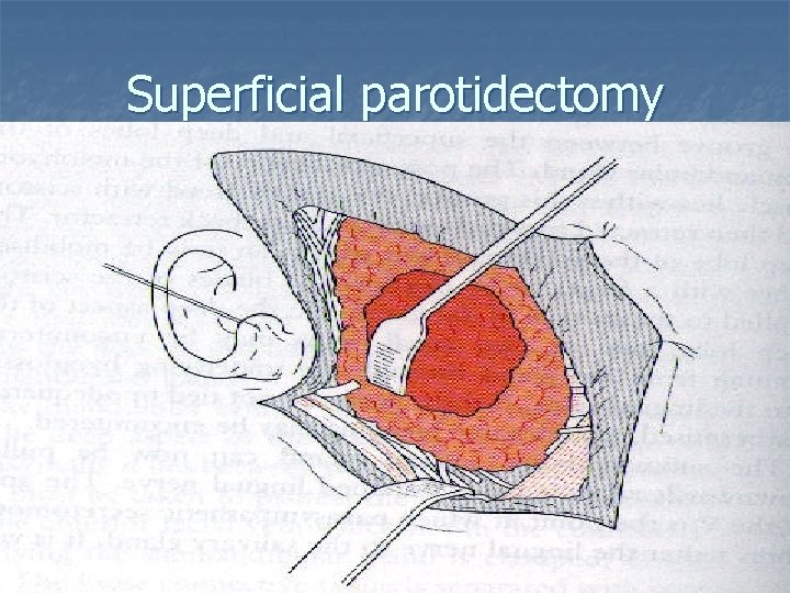 Superficial parotidectomy 