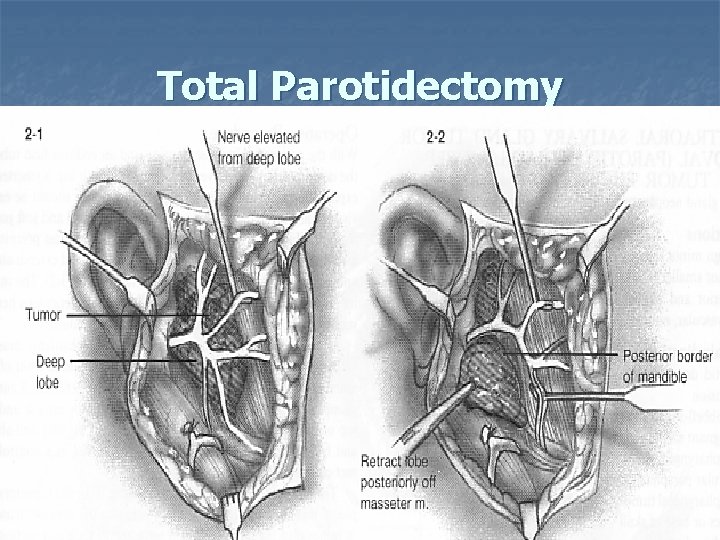 Total Parotidectomy 