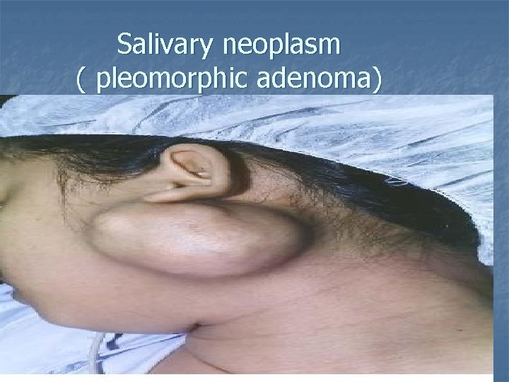 Salivary neoplasm ( pleomorphic adenoma) 