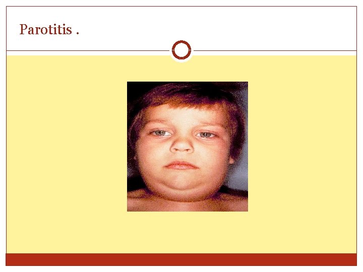 Parotitis. 