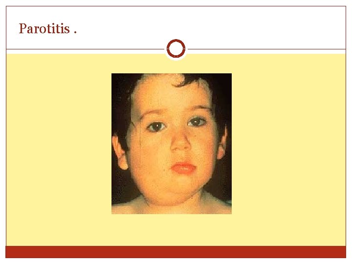 Parotitis. 
