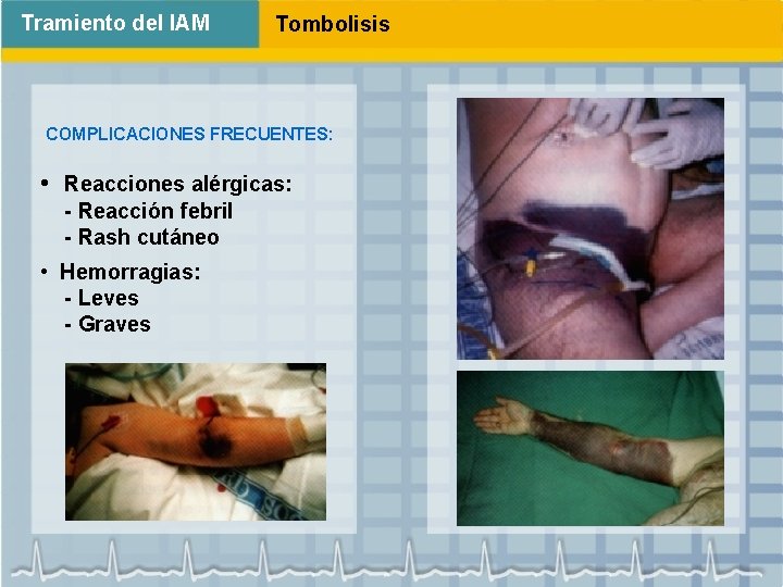 Tramiento del IAM Tombolisis COMPLICACIONES FRECUENTES: • Reacciones alérgicas: - Reacción febril - Rash