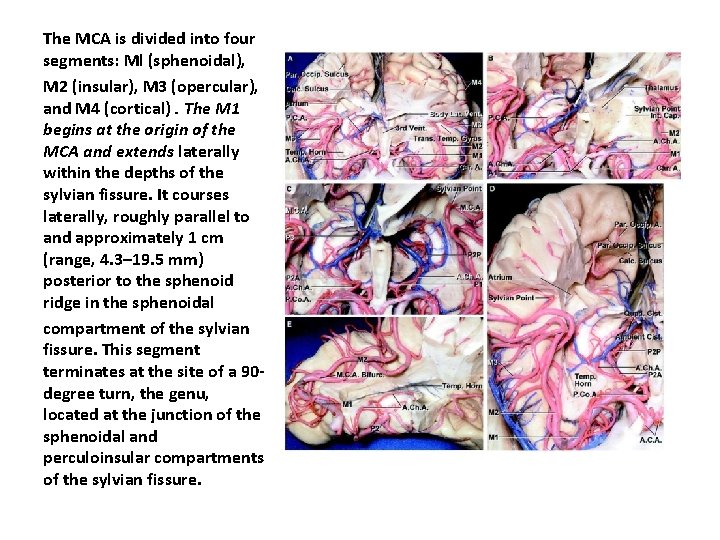 The MCA is divided into four segments: Ml (sphenoidal), M 2 (insular), M 3