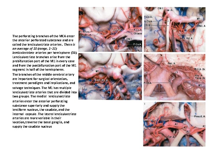 The perforating branches of the MCA enter the anterior perforated substance and are called