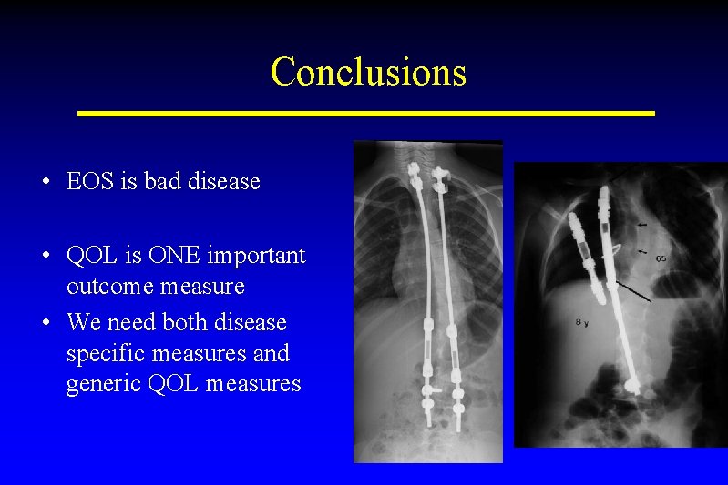 Conclusions • EOS is bad disease • QOL is ONE important outcome measure •