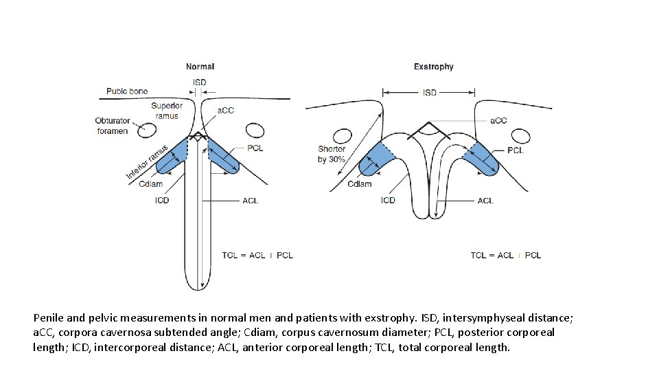 Penile and pelvic measurements in normal men and patients with exstrophy. ISD, intersymphyseal distance;