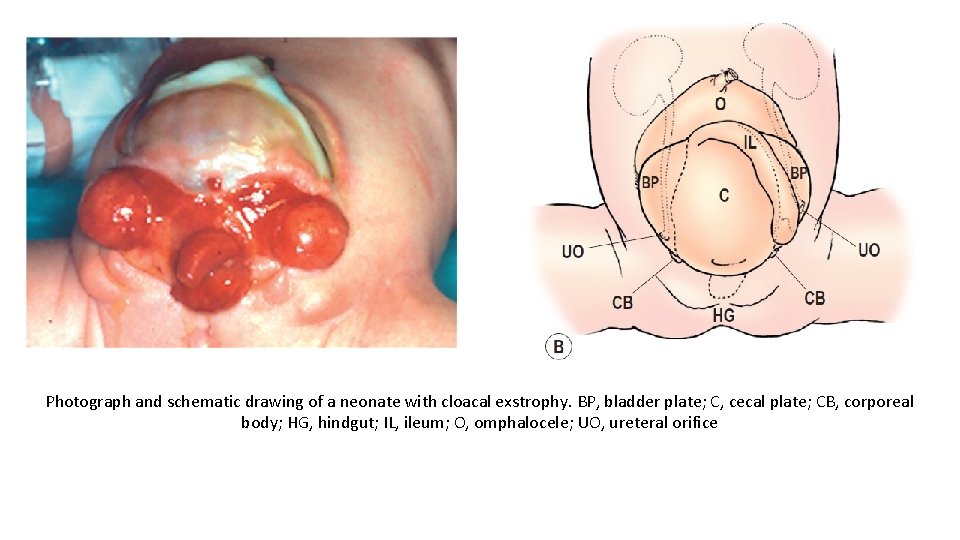 Photograph and schematic drawing of a neonate with cloacal exstrophy. BP, bladder plate; C,