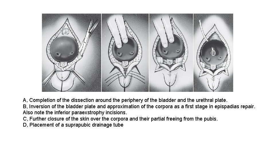 A, Completion of the dissection around the periphery of the bladder and the urethral